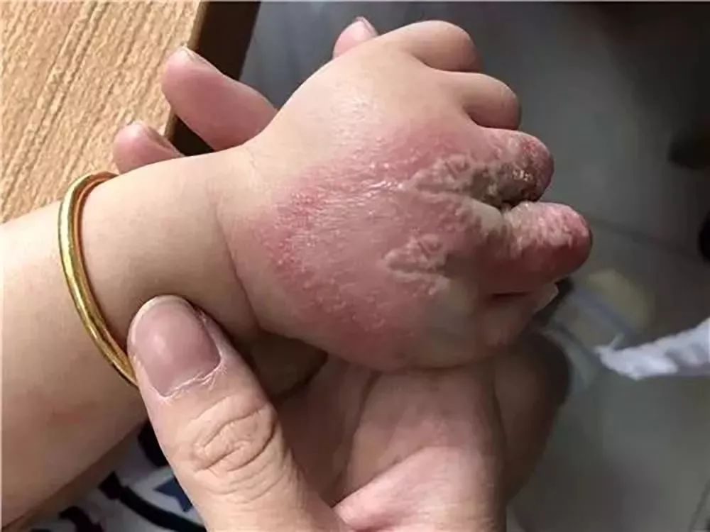 隱翅蟲的毒性有多強(qiáng)？體液比眼鏡蛇更毒，捕蠅草吸收它都會(huì)枯萎