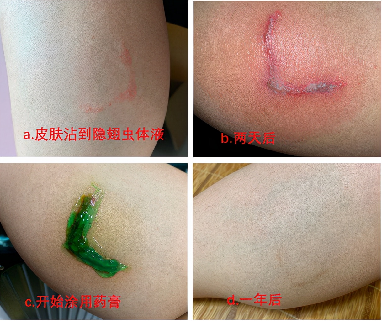 隱翅蟲的毒性有多強(qiáng)？體液比眼鏡蛇更毒，捕蠅草吸收它都會(huì)枯萎